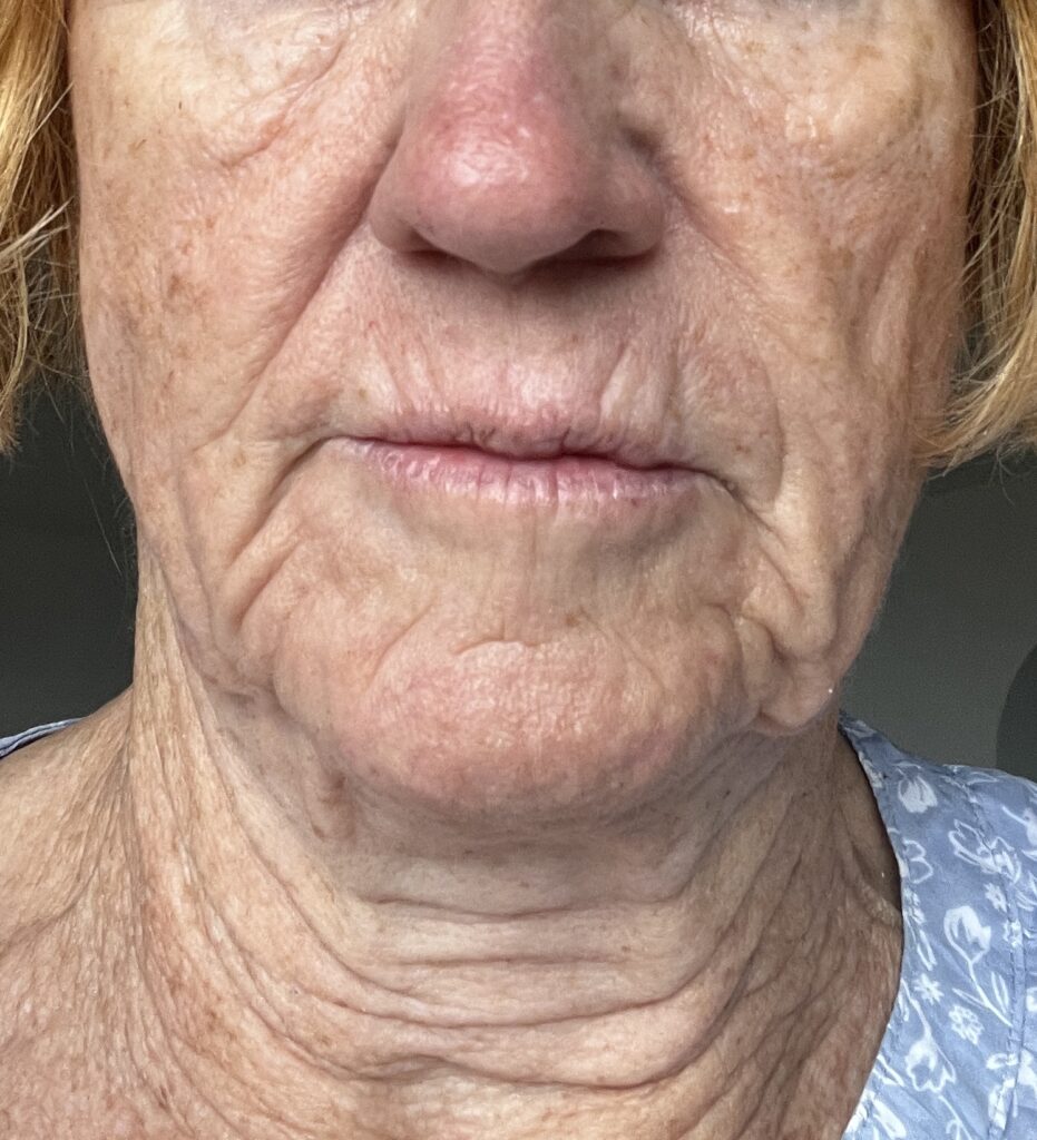 Mein Gescht vor der lLtherapy-Behandlung